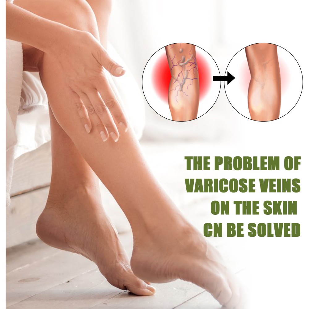Varicose Veins Cream, Vein Healing Varicose Veins Treatment Spray, Spider Veins Repair Cream